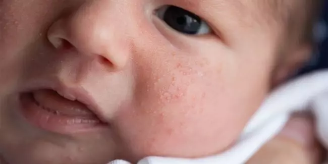 Northwest Family Clinics - Heat Rash in Babies.jpg